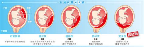 胎盤靠近子宮頸|胎盤前置及胎位不正